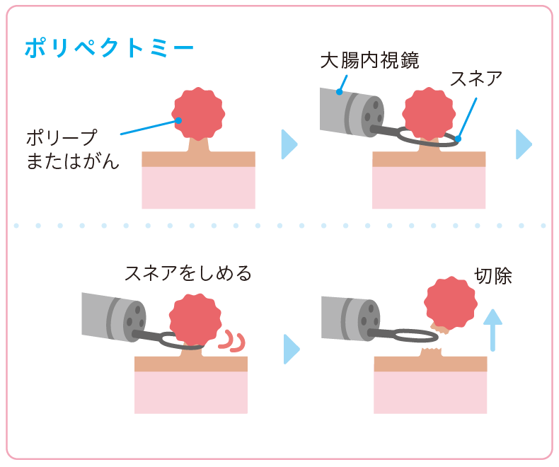ポリペクトミー