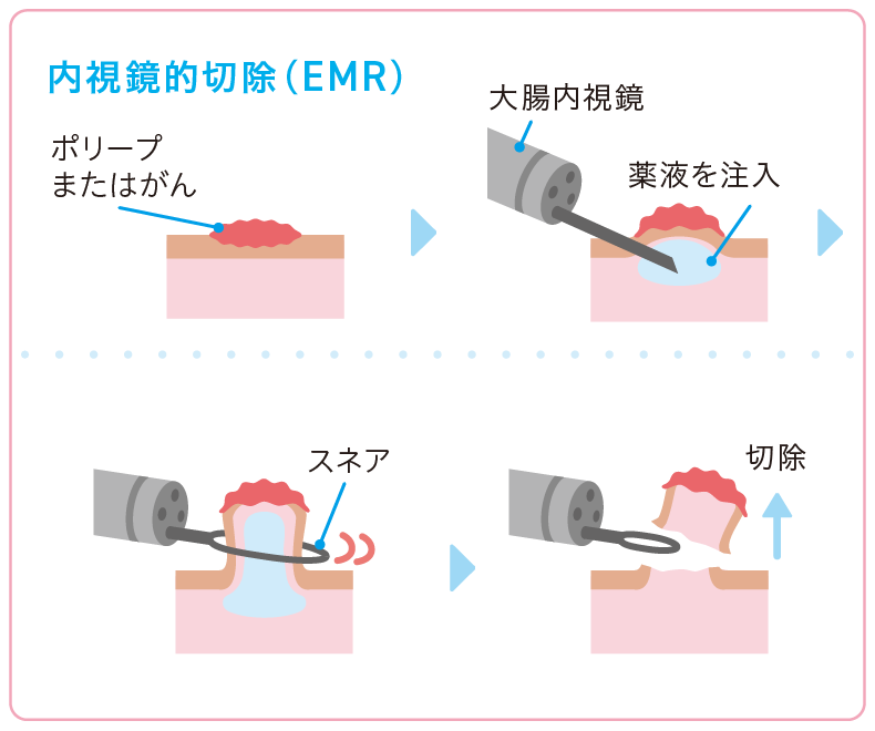 内視鏡的切除（EMR）